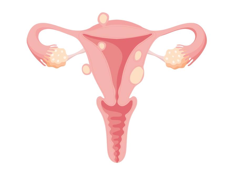 Fibroid - treatment