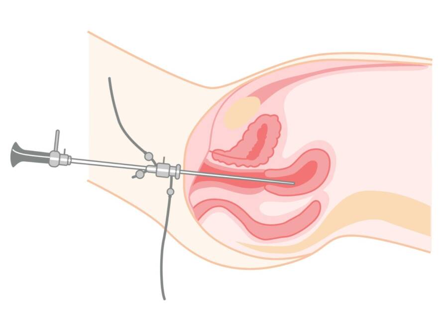 Hysterectomy - treatment