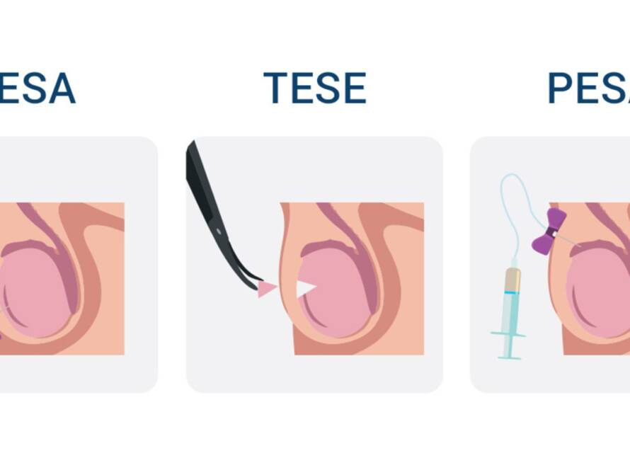 Male inferitility - treatment