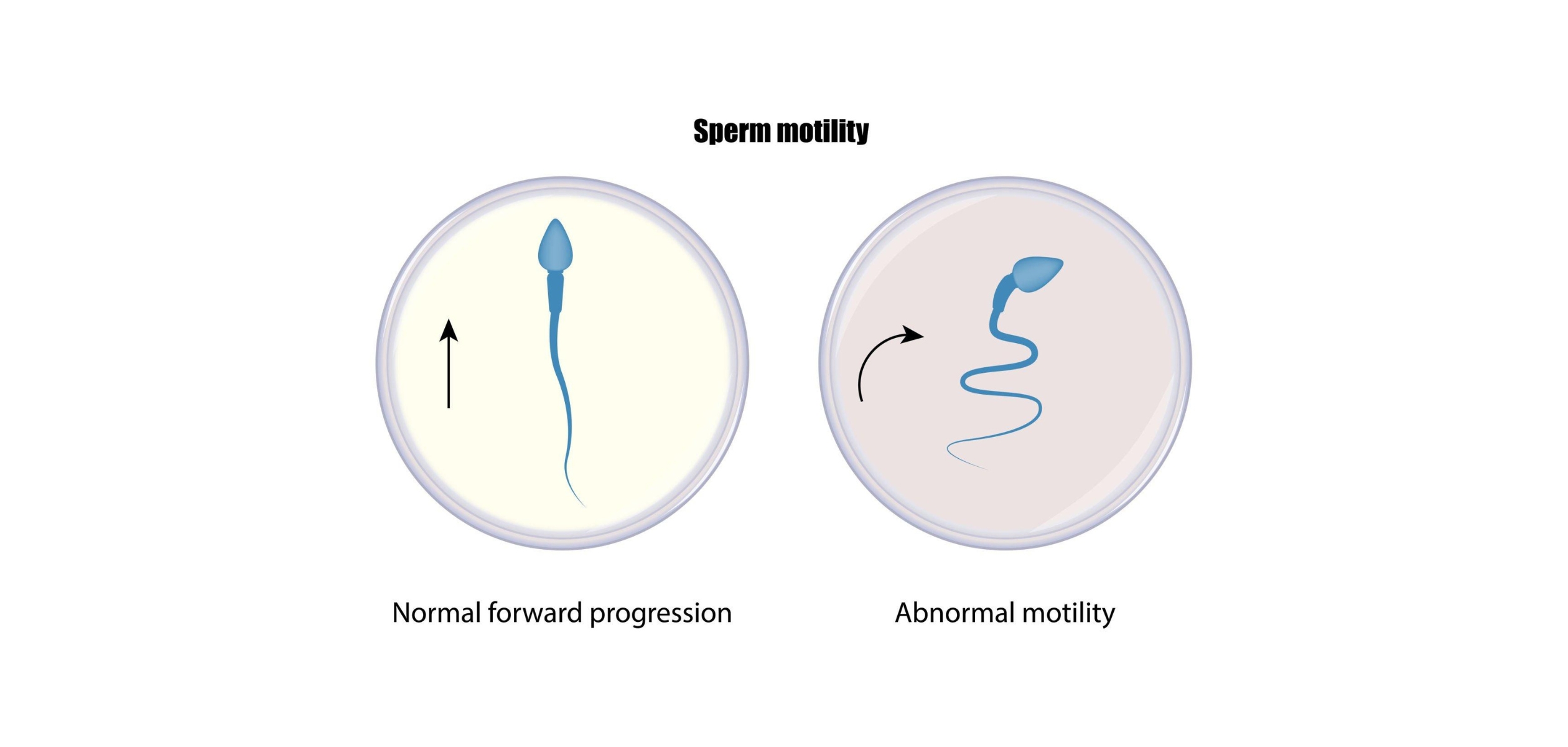 Low sperm motility