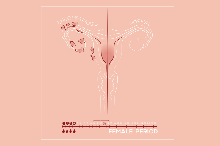 Endometriosis