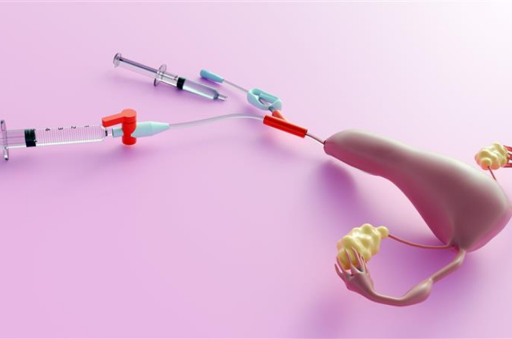 IUI (Intrauterine Insemination)