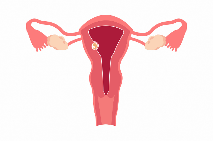 Recurrent Implantation Failure (RIF)